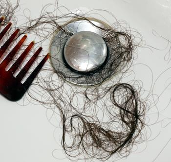 Treating Hair Loss
